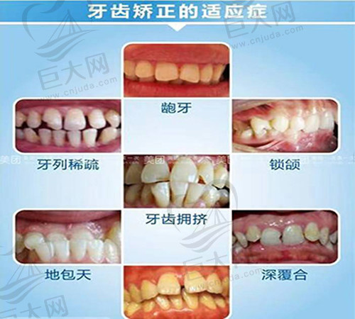 牙齿矫正适用症