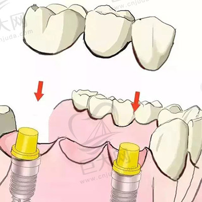 种植牙示意图