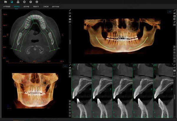 口腔CBCT三位一体机