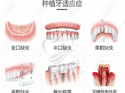 种植牙适用症