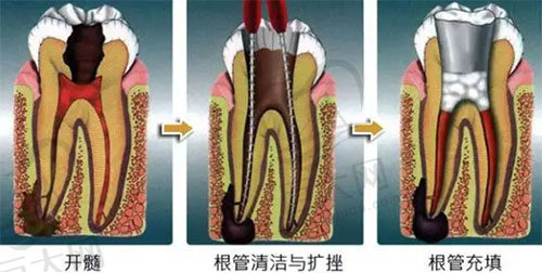 根管治疗