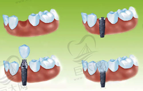 牙齿种植详细过程步骤