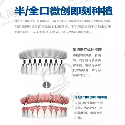 微创即刻种植