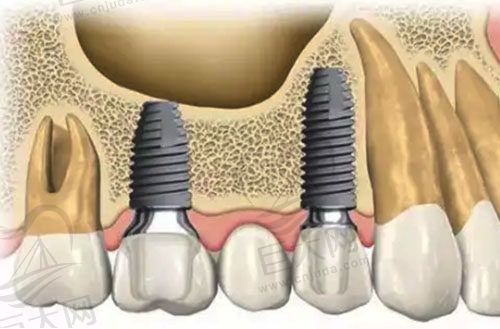 牙齿多颗缺失种植示范图