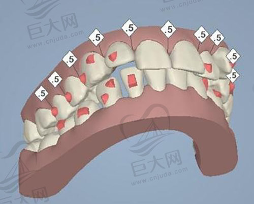 矫正牙齿