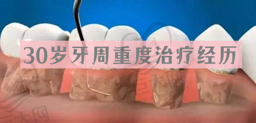 30岁牙周重度治疗经历