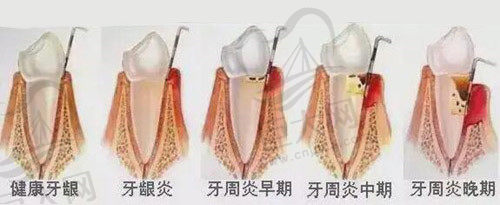 牙周炎发展