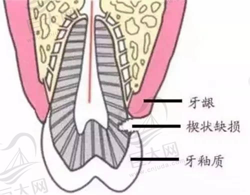 牙齿酸软