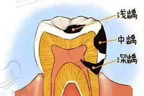 牙齿龋坏发展过程