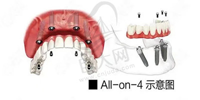 all-on-4种植技术