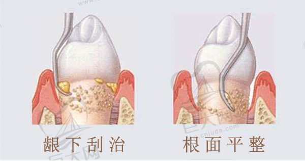 龈下刮治、根面平整