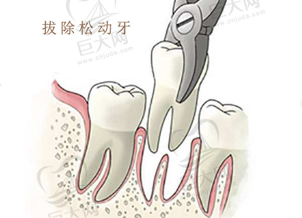 牙齿松动后拔除