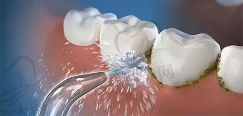 牙周基础治疗