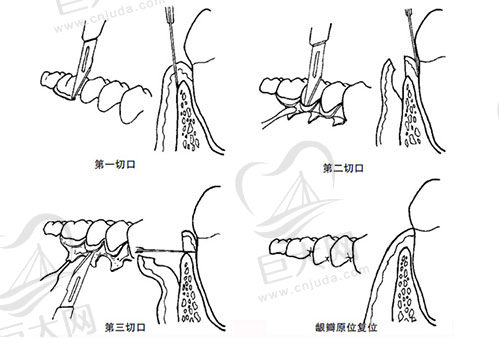 牙周翻瓣手术流程