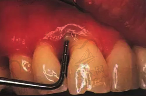 牙齿牙槽骨萎缩示范图