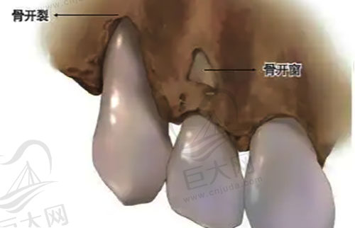 骨开裂和骨开窗区别对比