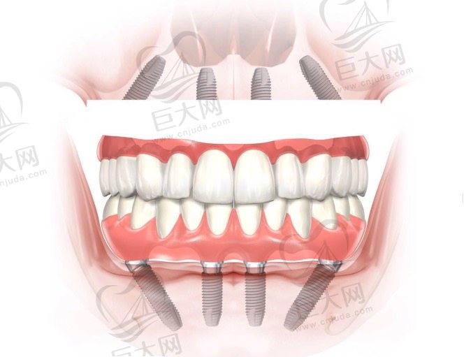All-on-4种植牙的适用人群