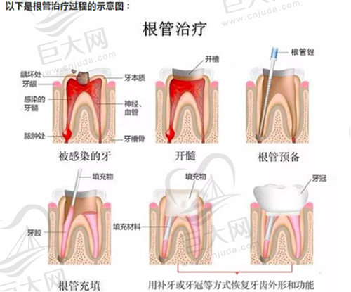 根管治疗