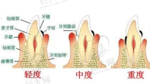 不同程度的牙周炎