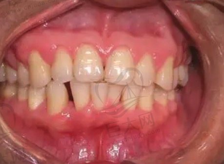 早期牙周炎图片