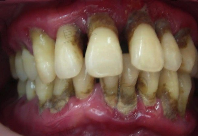 中期牙周炎图片