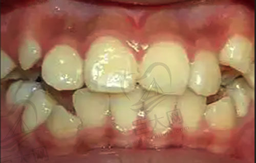 牙齿排列不齐问题示范图