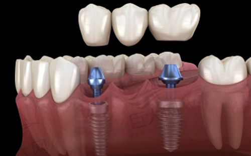 种植牙