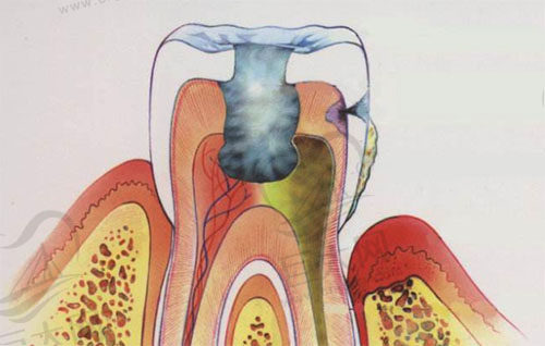牙髓炎