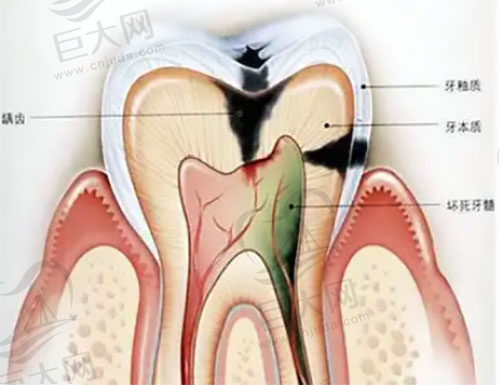 牙髓坏死
