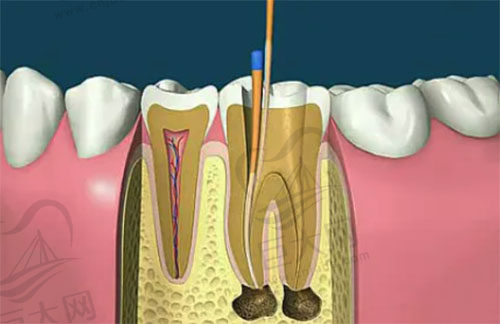 根管治疗