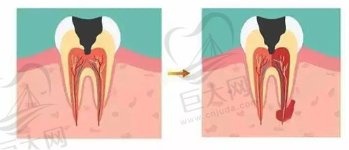 牙髓坏死