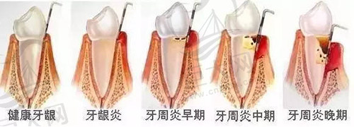 牙周刮治