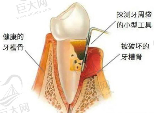 牙周刮治