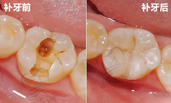 树脂材料补牙
