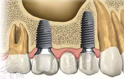 多颗牙齿种植示意图