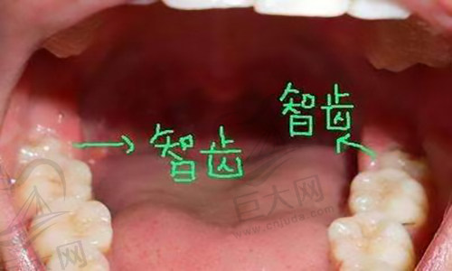 智齿在哪里