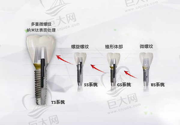 韩国OSSTEM奥齿泰种植牙