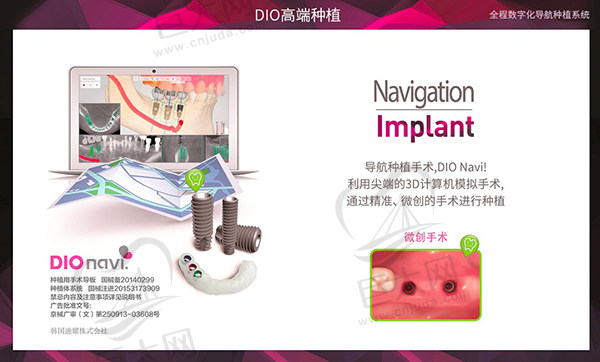 韩国DIO种植牙