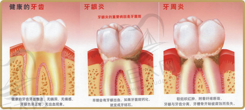 牙龈炎与牙周炎