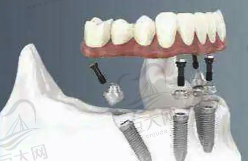 all-on-4牙齿种植技术
