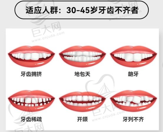 舌侧隐形矫正适应人群