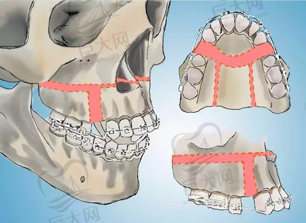 正畸正颌联合矫正