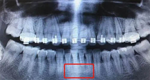 正畸牙根吸收