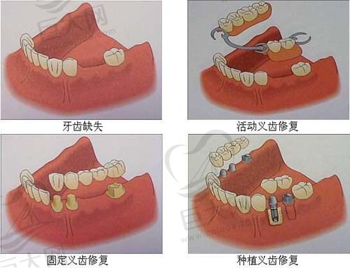 种植牙和假牙