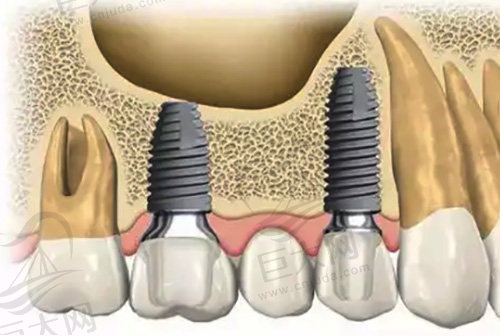 牙齿种植所需条件有哪些