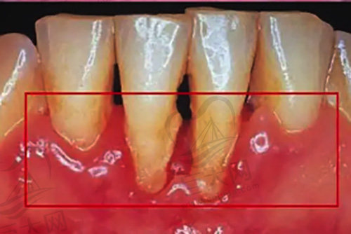 牙龈萎缩导致牙槽骨吸收