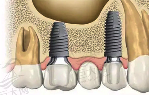 牙齿多颗缺失种植修复