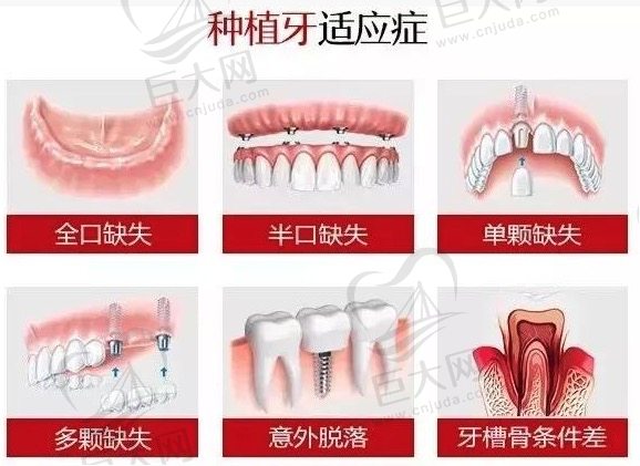 种植牙适应症