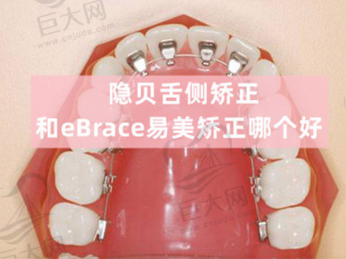 隐贝舌侧矫正和eBrace易美矫正哪个好