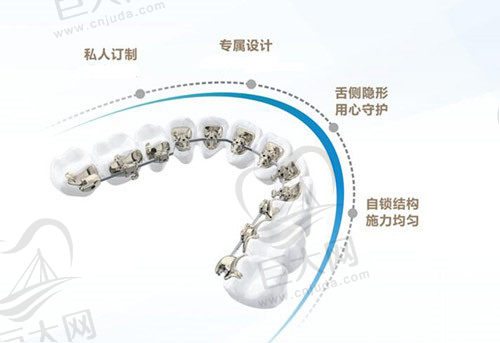 隐贝矫治器